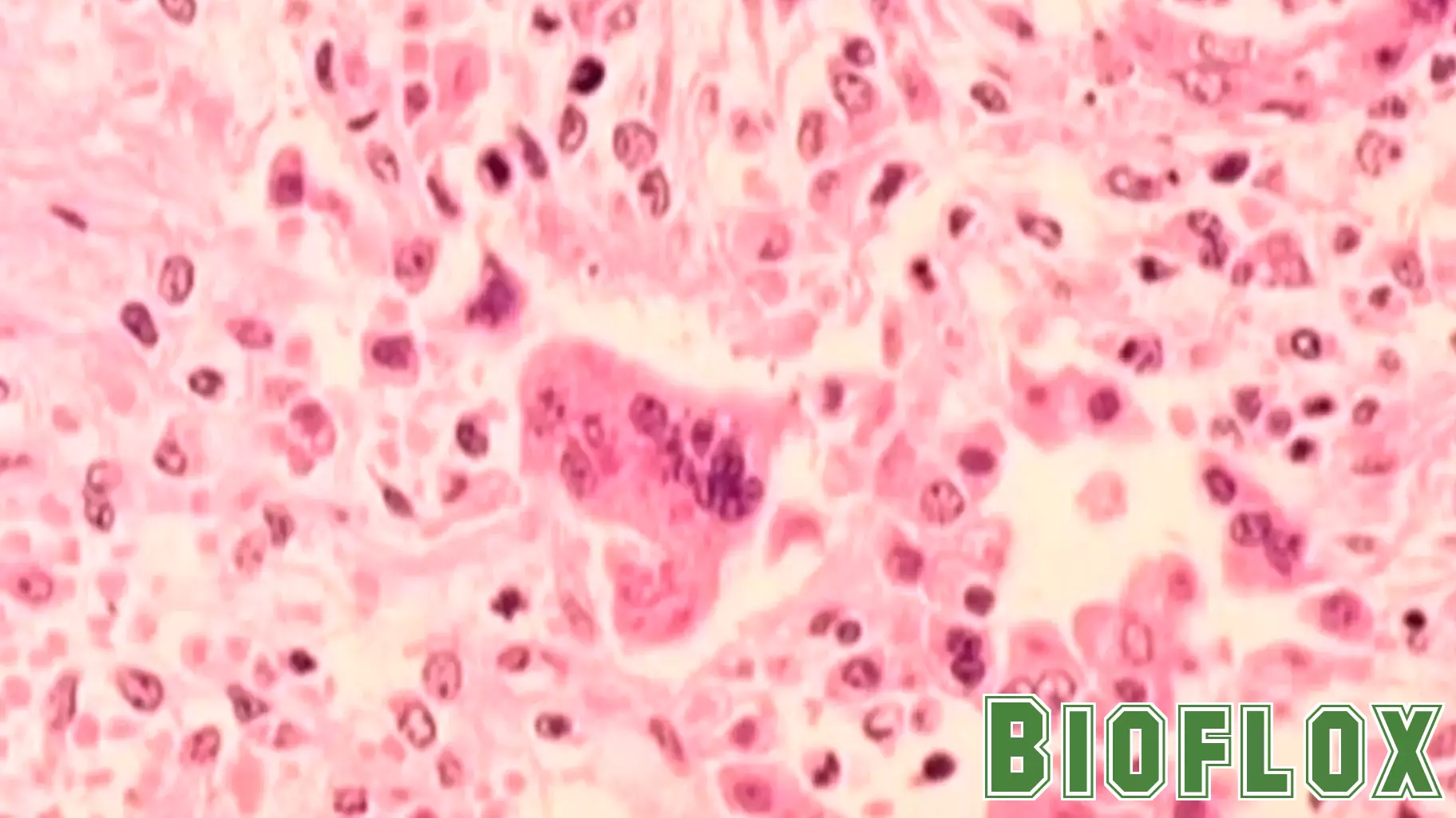 Fourth Measles Case Confirmed in Los Angeles County