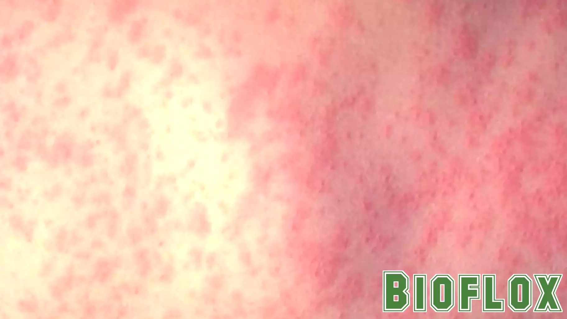 Second Measles Case Confirmed in Unvaccinated Infant in Denver