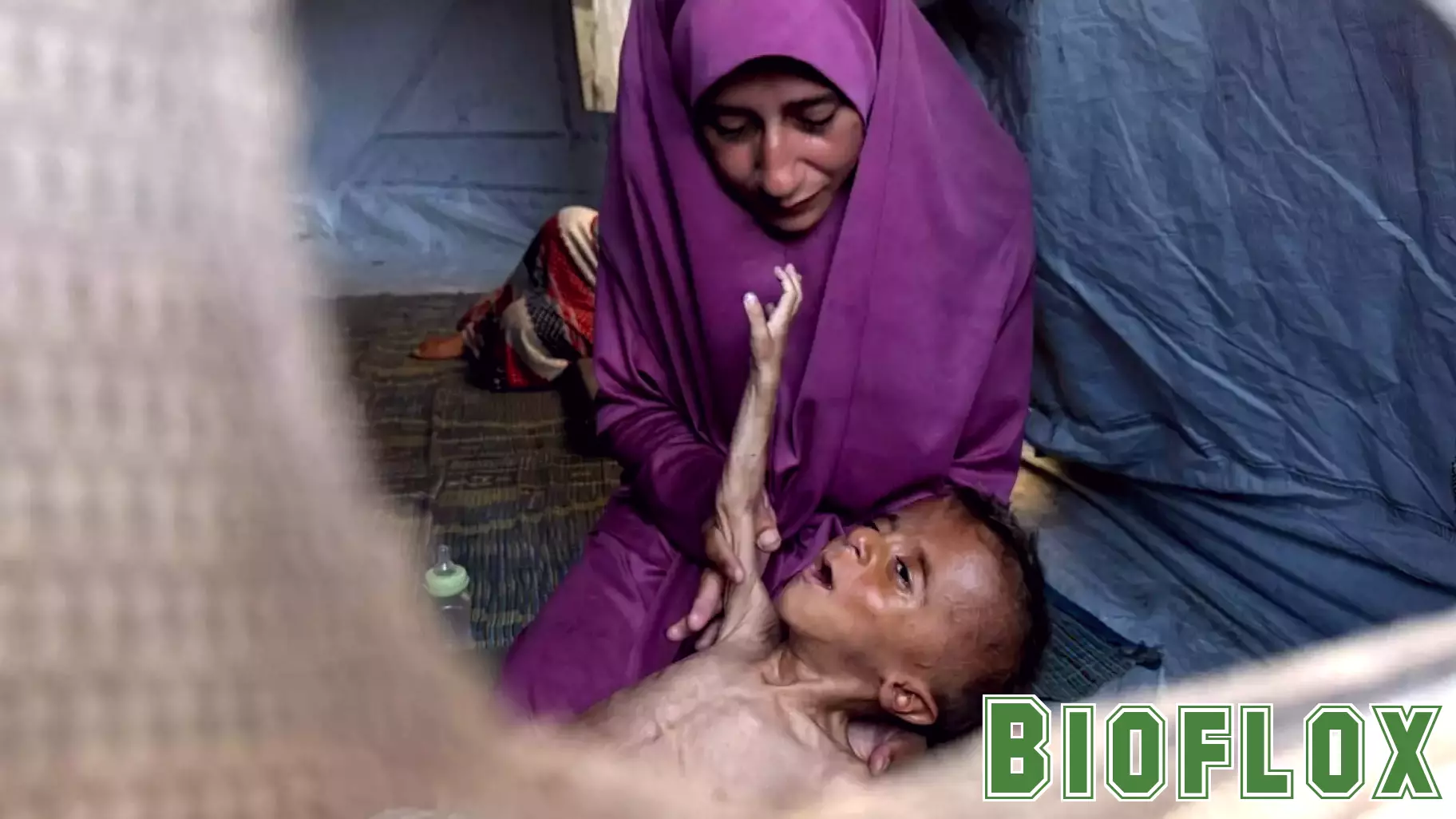 Young Child Faces Severe Malnutrition in Gaza