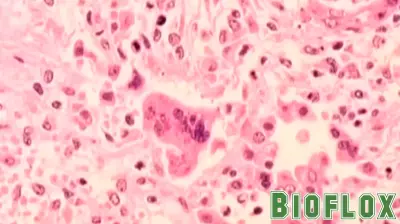 Fourth Measles Case Confirmed in Los Angeles County