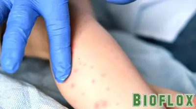 Health officials report 29 new measles cases, one in Sumter County