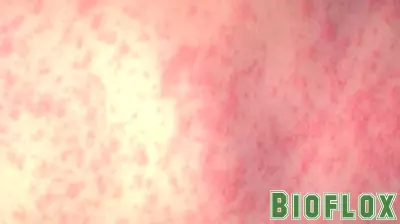 Second Measles Case Confirmed in Unvaccinated Infant in Denver